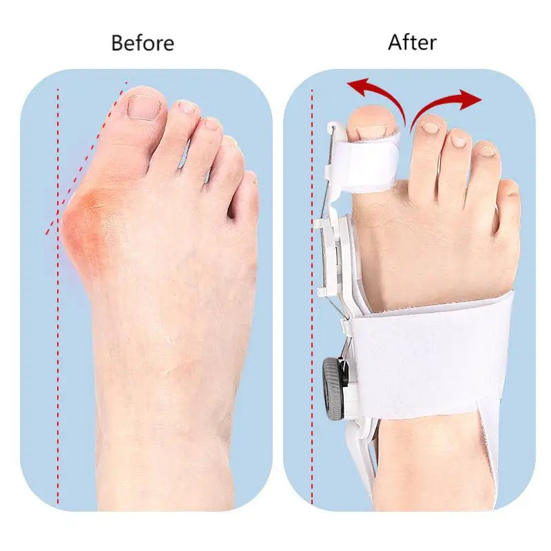 Correcteur d’Hallux Valgus Réglable